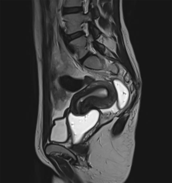 endometriose IRM imagerie diagnostic