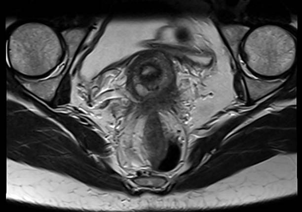 irm endométriose imagerie femme