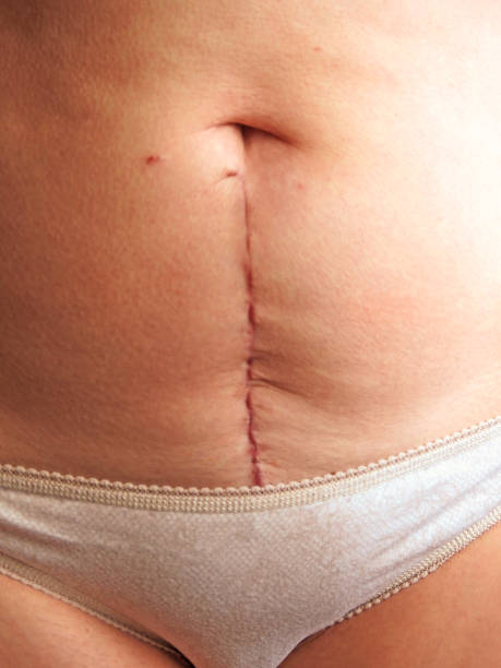 cicatrice, chirurgie gynecologique