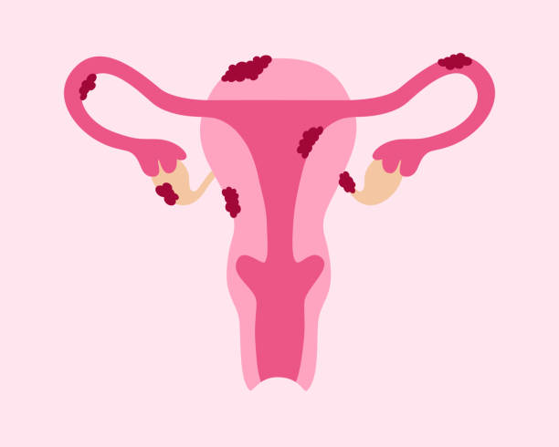 endometriose
