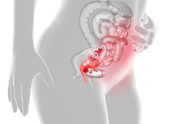 endometriose