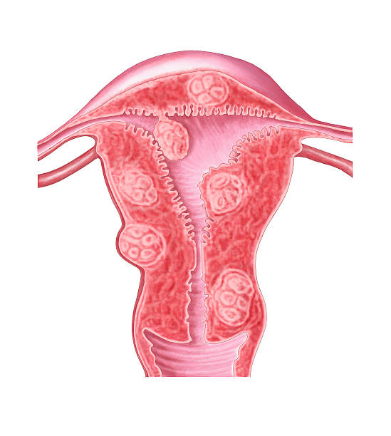 fibrome de l'utérus femme