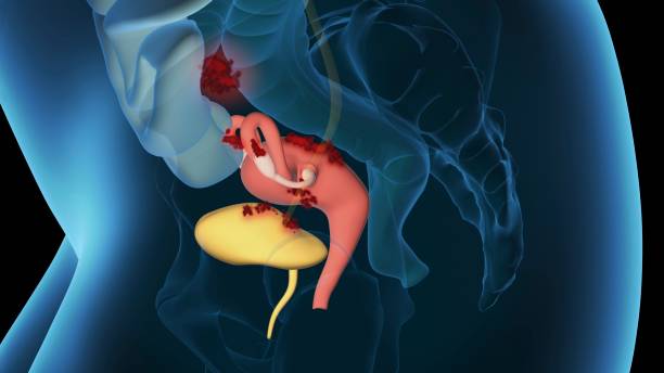 endometriose