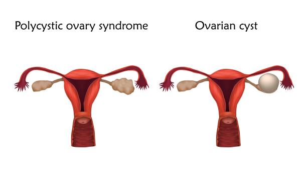 ovaires, kyste ovarien, SOPK