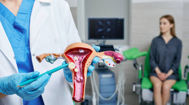 fibrome de l'utérus chez la femme