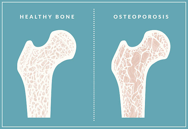osteoporose