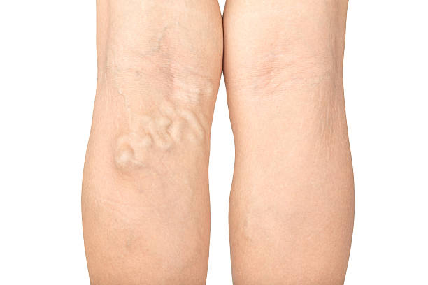 varices